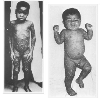 monkeypox